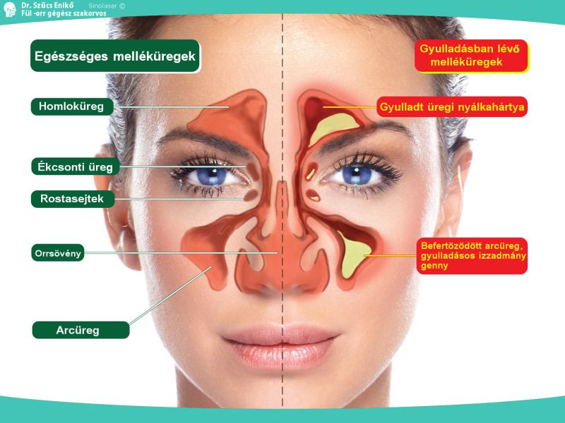 Az arcüreggyulladás kialakulása és kezelése